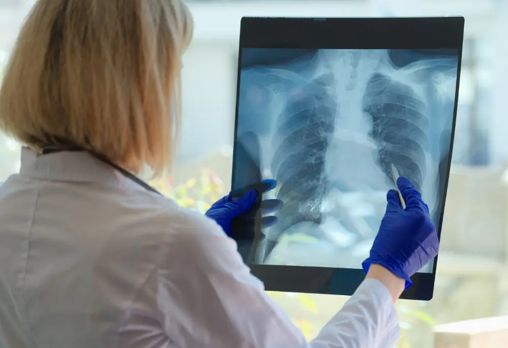 Lekarka przyglądająca się RTG płuc - możliwa mukowiscydoza, zakażenie Pseudomonas